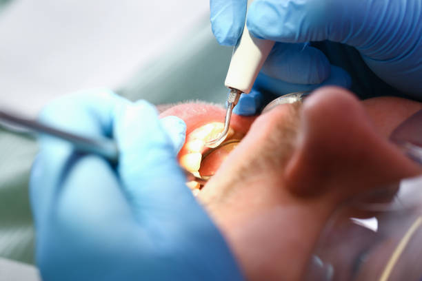 Best Emergency Dental Care for Broken or Chipped Teeth in Robert Lee, TX