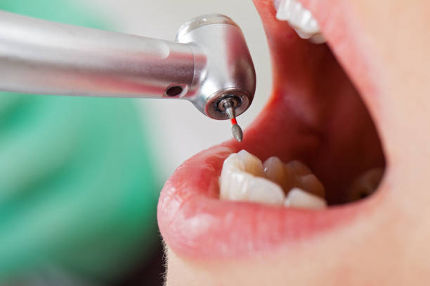 Best Urgent Care for Lost Fillings or Crowns in Robert Lee, TX